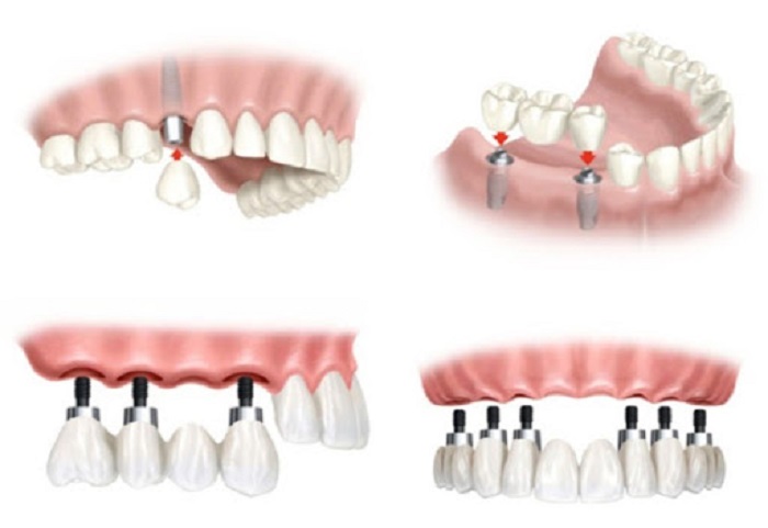 trồng răng Implant là gì