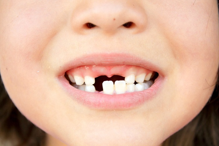 trồng răng Implant mất bao nhiêu thời gian