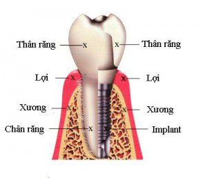 trồng răng Implant mất bao nhiêu thời gian