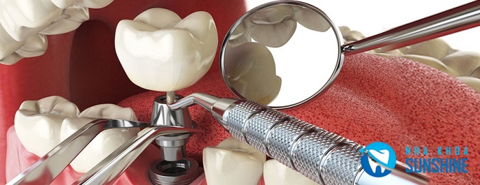 trồng răng Implant mất bao nhiêu thời gian