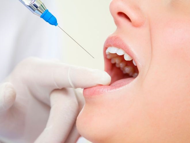 trồng răng Implant mất bao nhiêu thời gian