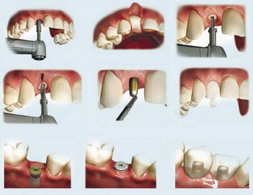 trồng răng Implant mất thời gian bao lâu