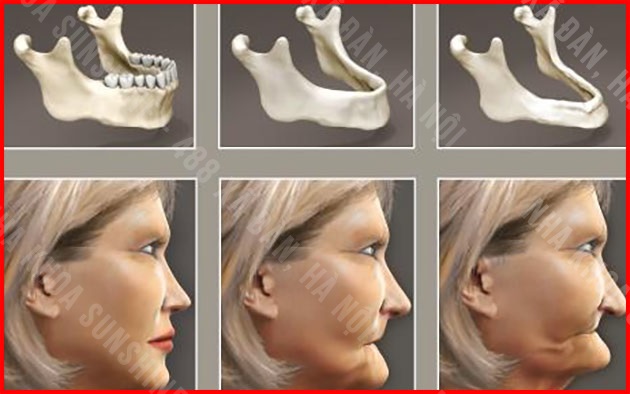 trồng răng Implant ở đâu tốt