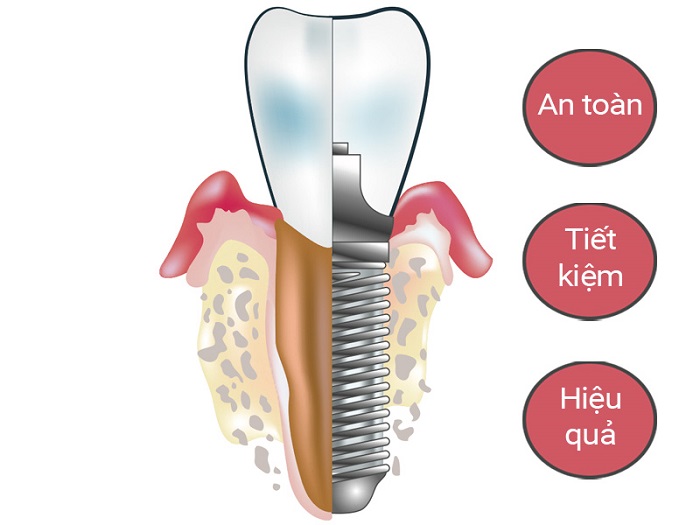trồng răng Implant trả góp