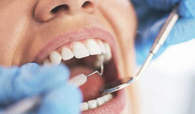 trồng răng Implant trả góp
