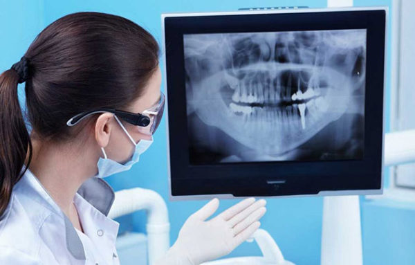 trồng răng Implant trong bao lâu