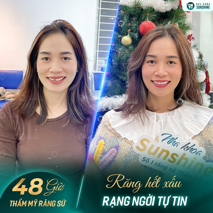 Cách làm trắng răng bằng chanh Cách làm trắng răng bằng chanh