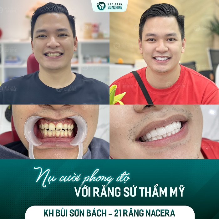 Cách làm trắng răng bằng muối