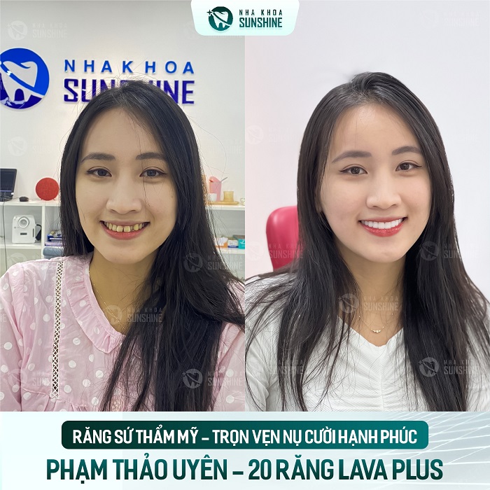 Cách làm trắng răng bằng soda Cách làm trắng răng bằng soda