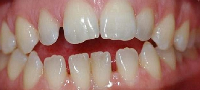 Cách lấy cao răng tại nhà webtretho