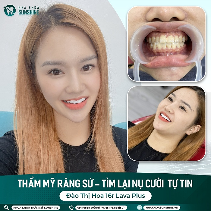 Làm trắng răng an toàn