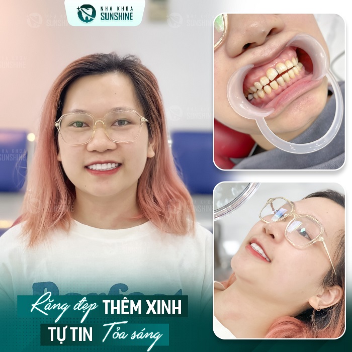 Làm trắng răng bằng laser có hại không