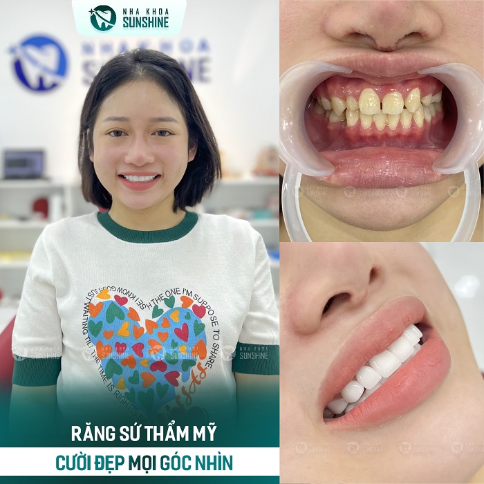 Làm trắng răng có tốt không