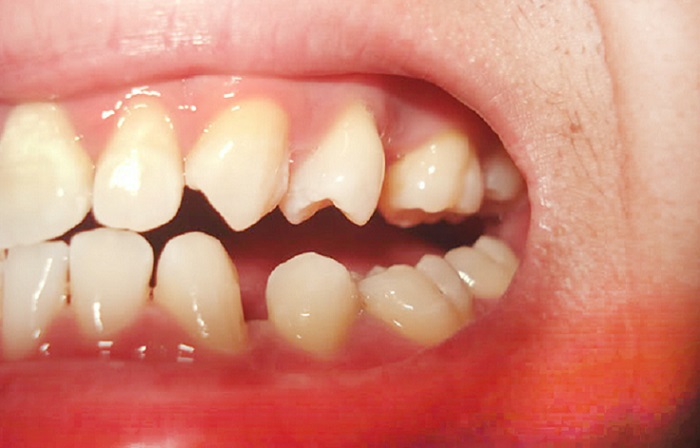 Lấy cao răng siêu âm hà nội