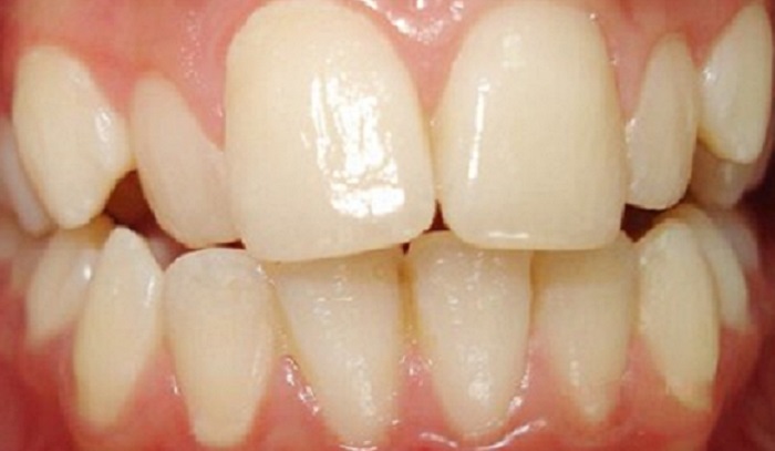 Răng bị ê buốt sau khi lấy cao răng