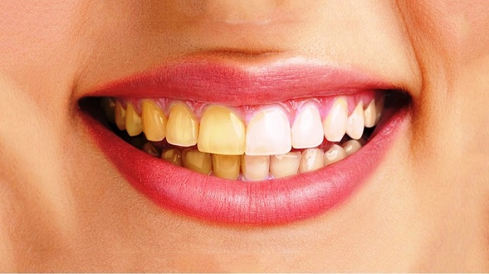Làm trắng răng nhanh hiệu quả