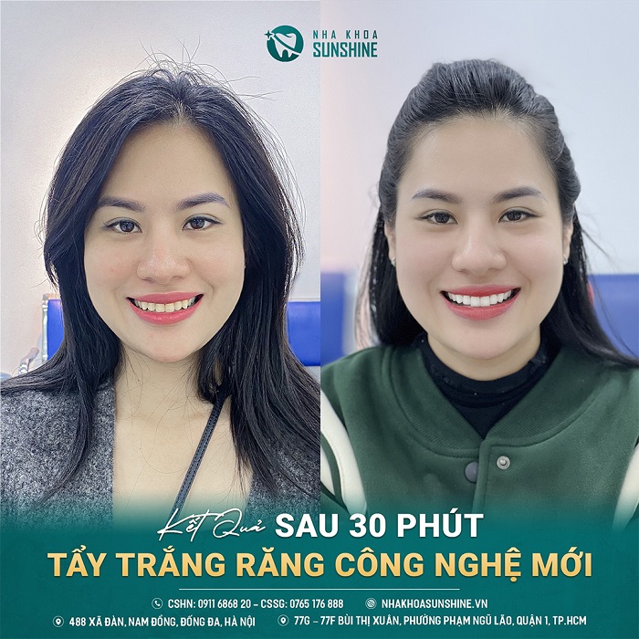 Tẩy trắng răng có đau không Tẩy trắng răng có đau không