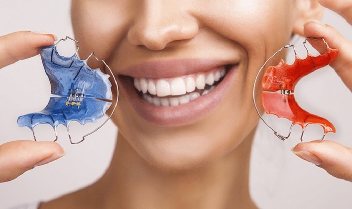 niềng răng xong đeo hàm duy trì bao lâu