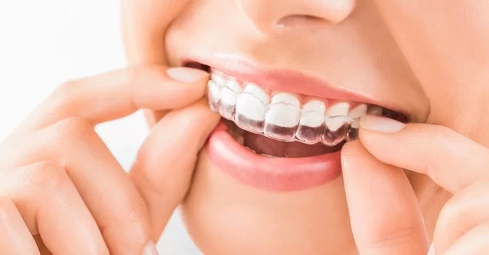 niềng răng 3d clear dưới 6 tháng