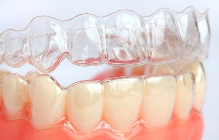 niềng răng trong suốt có hiệu quả không