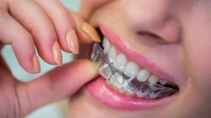 chi phí niềng 2 răng cửa