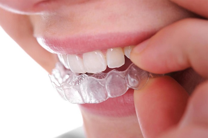 niềng răng không mắc cài tại Hà Nội