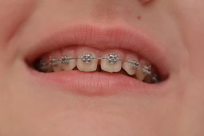 niềng răng có hết thưa không