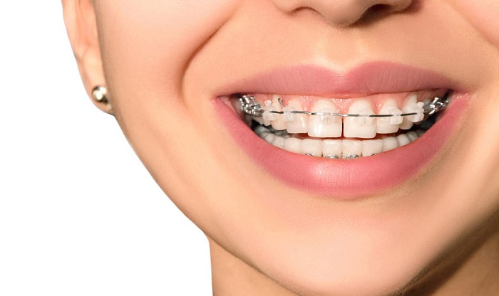 niềng răng thưa có lâu không
