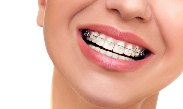 niềng răng hô 1 hàm giá bao nhiêu niềng răng hô 1 hàm giá bao nhiêu
