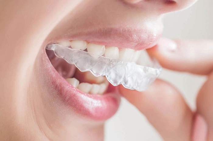 niềng răng không mắc cài 3d Clear Aligner