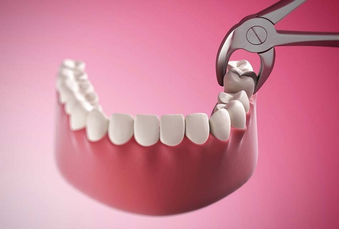 niềng răng có nhổ răng mất bao lâu