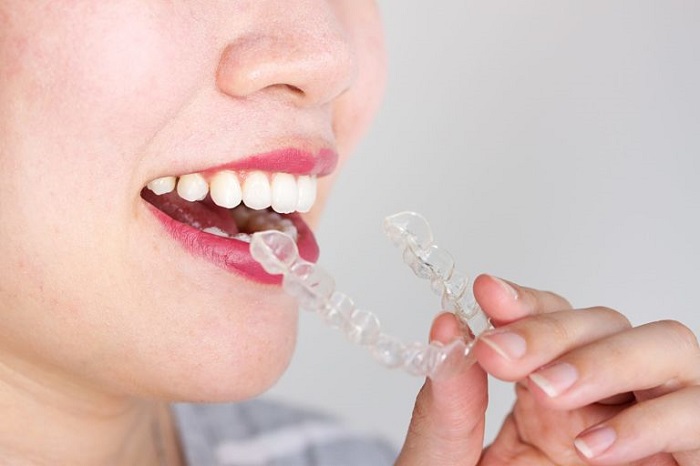 niềng răng 3d clear trả góp
