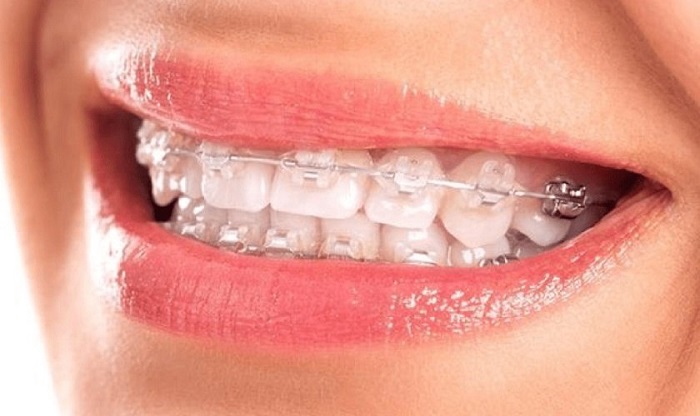niềng răng hô mắc cài trong suốt