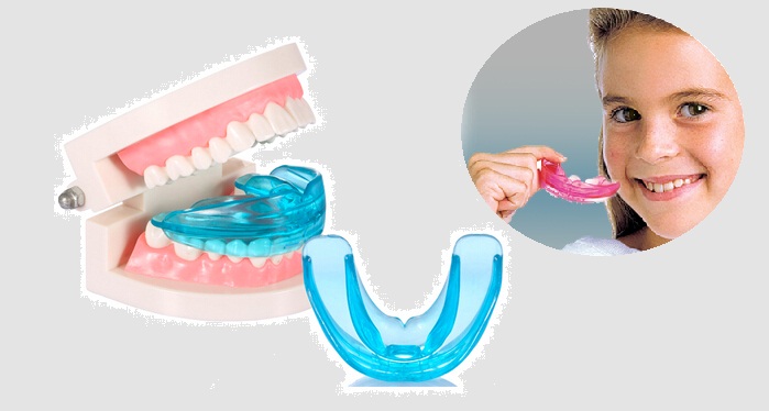 niềng răng nhựa cho trẻ em niềng răng nhựa cho trẻ em
