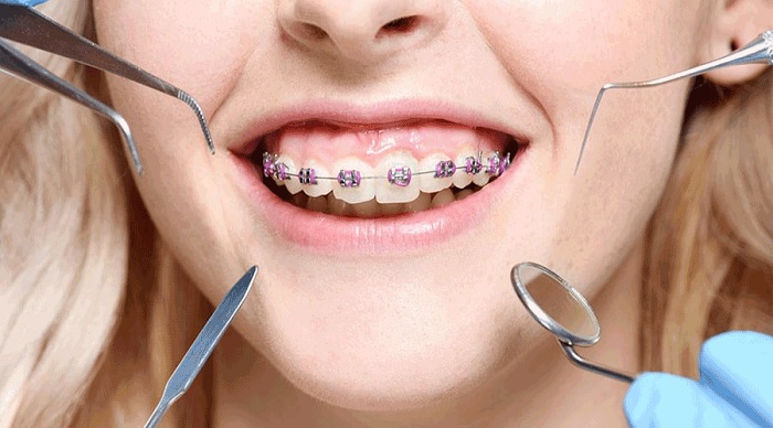 niềng răng phải mất bao lâu