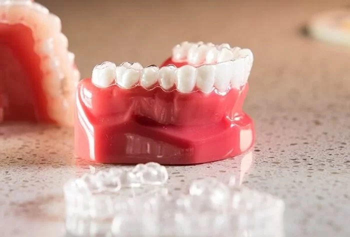 niềng răng Clear Aligner có hiệu quả không