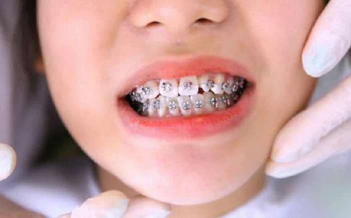 niềng răng giá rẻ Cần Thơ niềng răng giá rẻ Cần Thơ