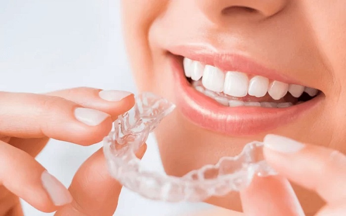niềng răng art Clear Aligner