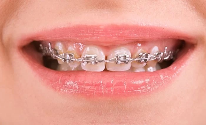 tác dụng của niềng răng thưa