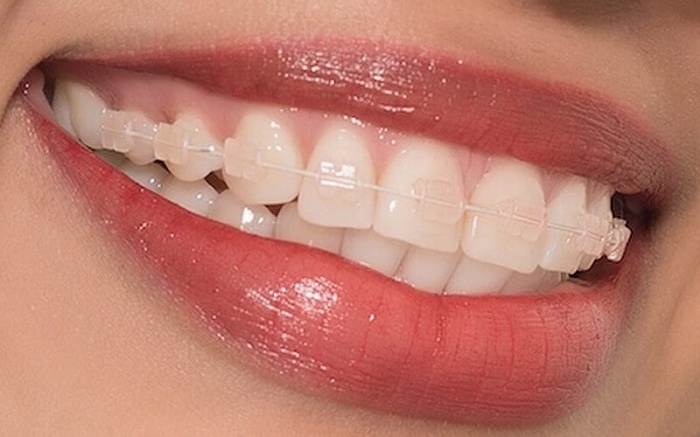 Niềng răng mắc cài sứ trong suốt