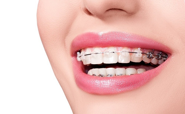 Niềng răng bị hóp má và thái dương Niềng răng bị hóp má và thái dương