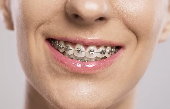 Niềng răng trả góp Bình Dương