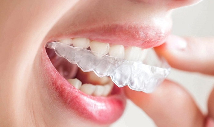Bảng giá niềng răng trong suốt