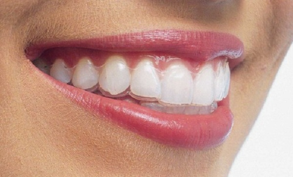 Niềng răng không mắc cài là gì