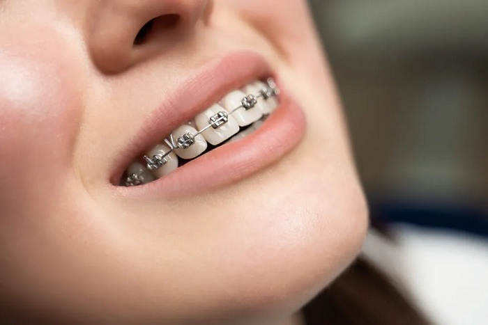 Niềng răng trả góp Hải Dương