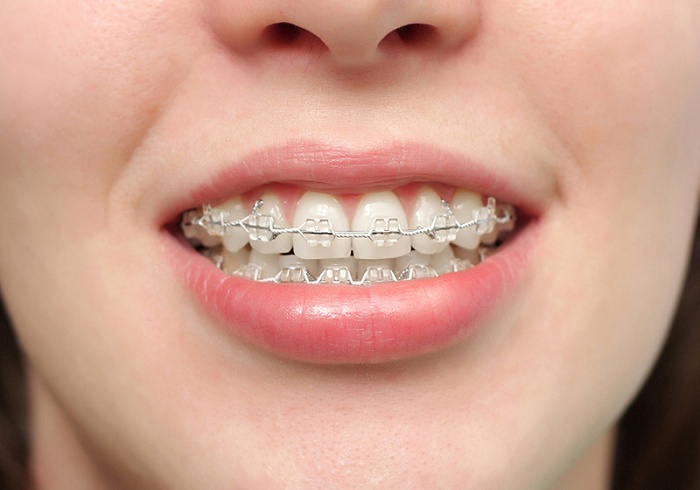 Niềng răng mắc cài pha lê trong suốt