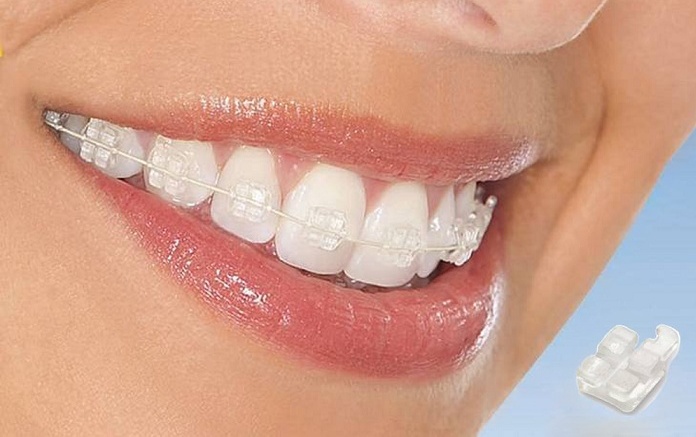 Niềng răng trả góp giá rẻ