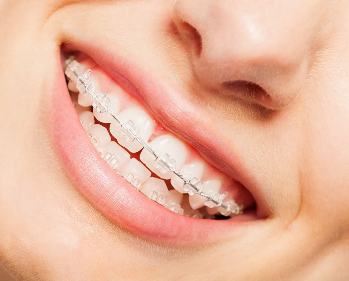 Niềng răng trả góp quận 7
