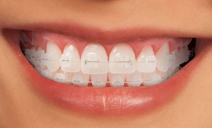 Niềng răng trả góp quận 7