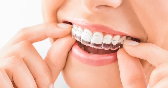 Niềng răng trong suốt Clear Aligner giá bao nhiêu